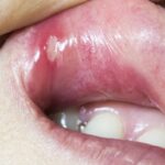 Llagas bucales: síntoma del VIH y su tratamiento