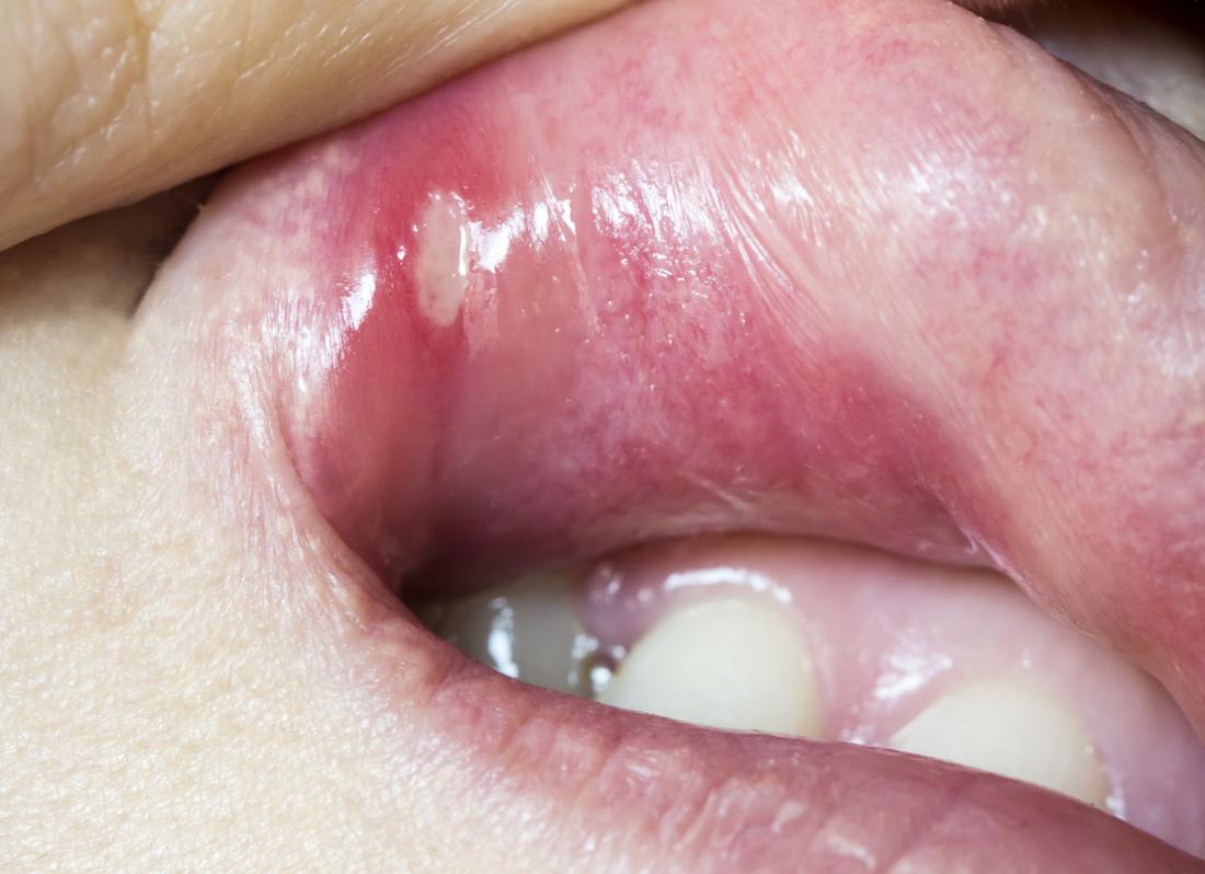 Llagas bucales: síntoma del VIH y su tratamiento