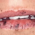 Manchas negras en los labios: causas y tratamientos
