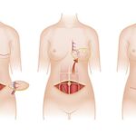 Mastectomía con Reconstrucción: ¿Implantes o Tejido Propio?
