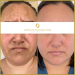 Melasma: prevención y cuidado durante el embarazo