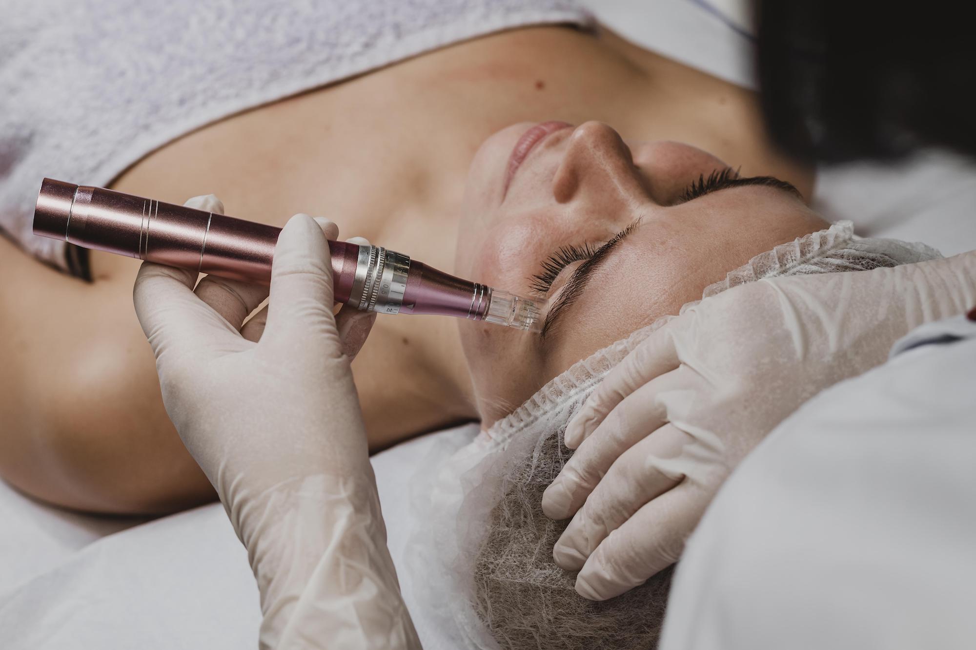 Microneedling: Piel renovada, cuidados post-tratamiento