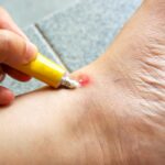 Mosquitos: Picaduras, remedios y prevención