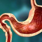 Mucosa eritematosa: Inflamación digestiva y sus síntomas