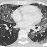 Opacidades Vidrio Esmerilado: Diagnóstico Pulmonar