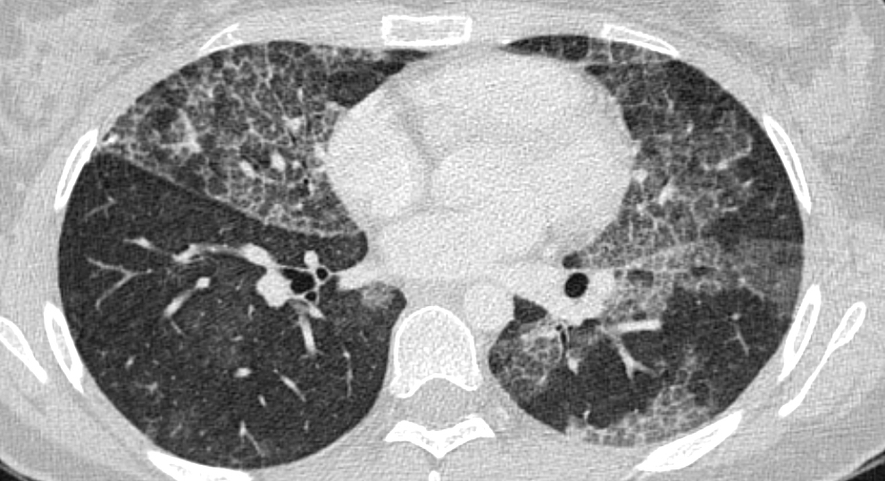 Opacidades Vidrio Esmerilado: Diagnóstico Pulmonar