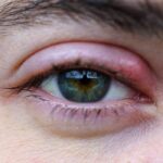 Orzuelos: Causas, síntomas y cuándo consultar.