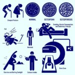 Osteoporosis: Prevención y control eficaz