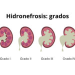 Pelvicaliectasia: Dilatación Renal, Diferencias con Hidronefrosis