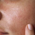 Piel grasa: Hidratación natural, ¡sin obstruir poros!