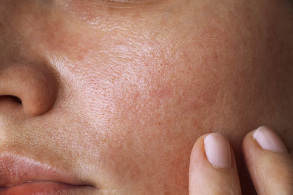 Piel grasa: Hidratación natural, ¡sin obstruir poros!