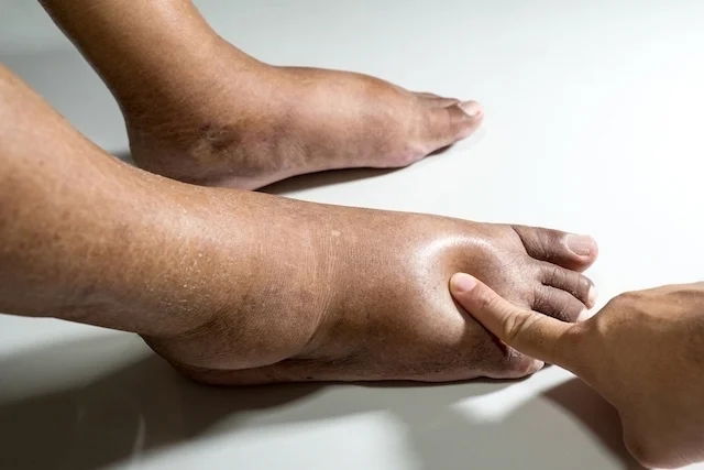 Pies Fríos: Señales de Problemas Circulatorios