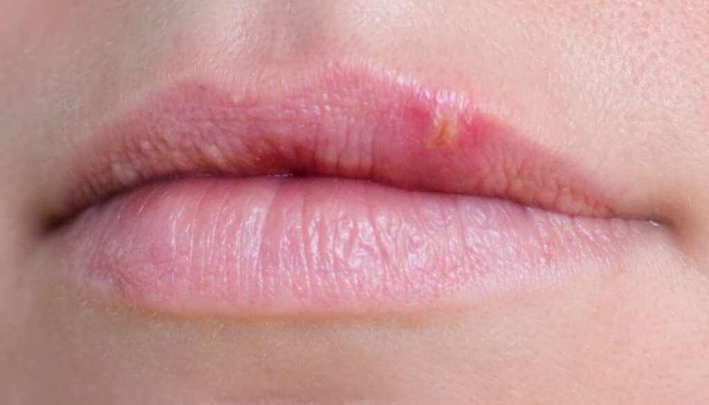 Protuberancias en los labios: Causas y tratamientos