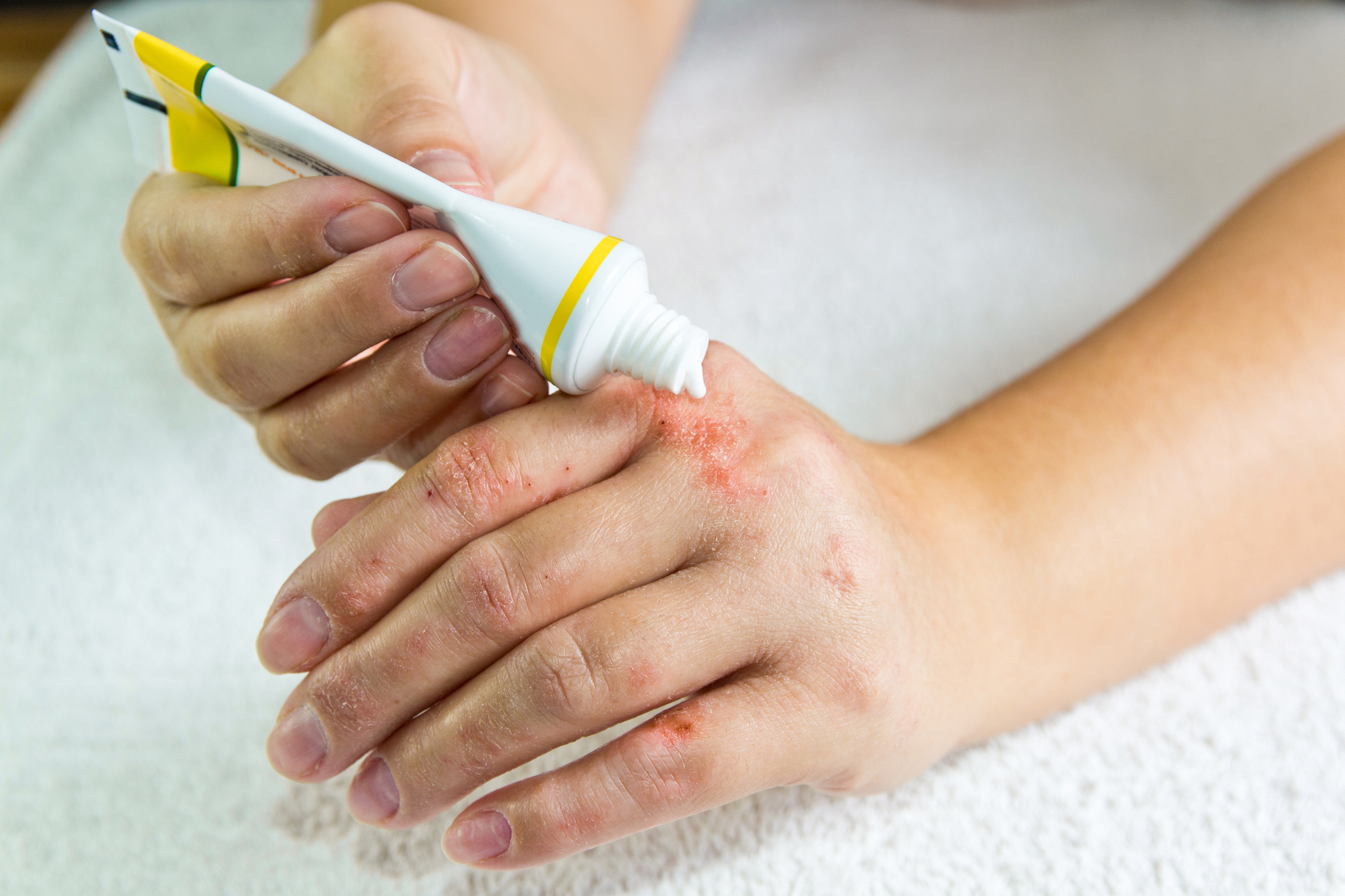 Psoriasis: alivio con tratamientos tópicos y médicos
