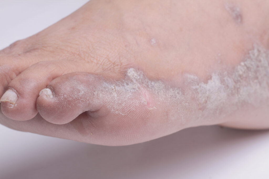 Psoriasis en los pies: Guía completa al tratamiento