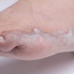 Psoriasis en los pies: Guía completa al tratamiento