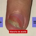 Psoriasis Ungueal: Diagnóstico y Tratamiento Integral
