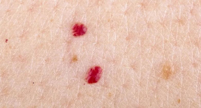 Puntos rojos en la piel: ¿Qué significan?