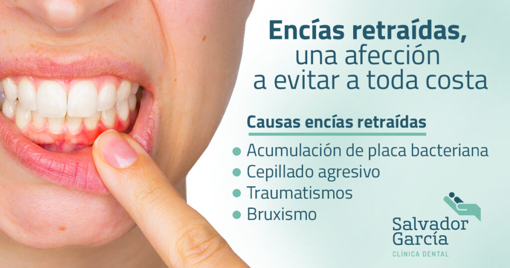 Retracción de encías: prevención y tratamiento