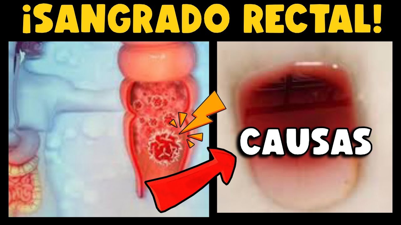Sangrado Rectal: Causas, Síntomas y Tratamiento