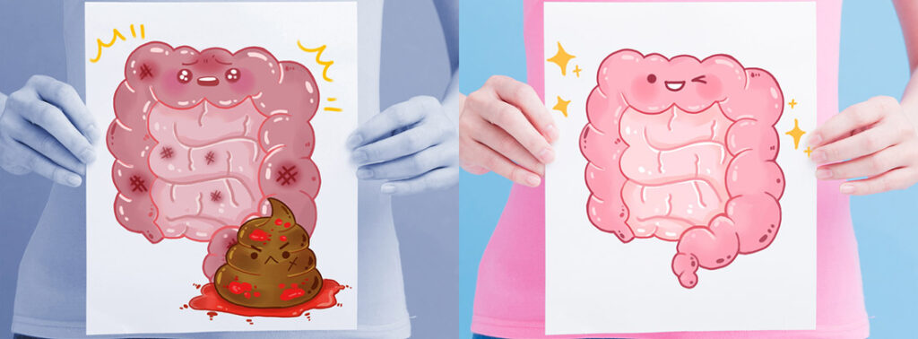 Sangre en Heces: Causas y Cuándo Consultar