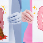 Sangre en Heces: Causas y Cuándo Consultar