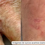 Sarna: Síntomas, Diagnóstico y Tratamiento