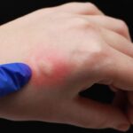 Síndrome de Skeeter: Reacción Alérgica Grave a Mosquitos