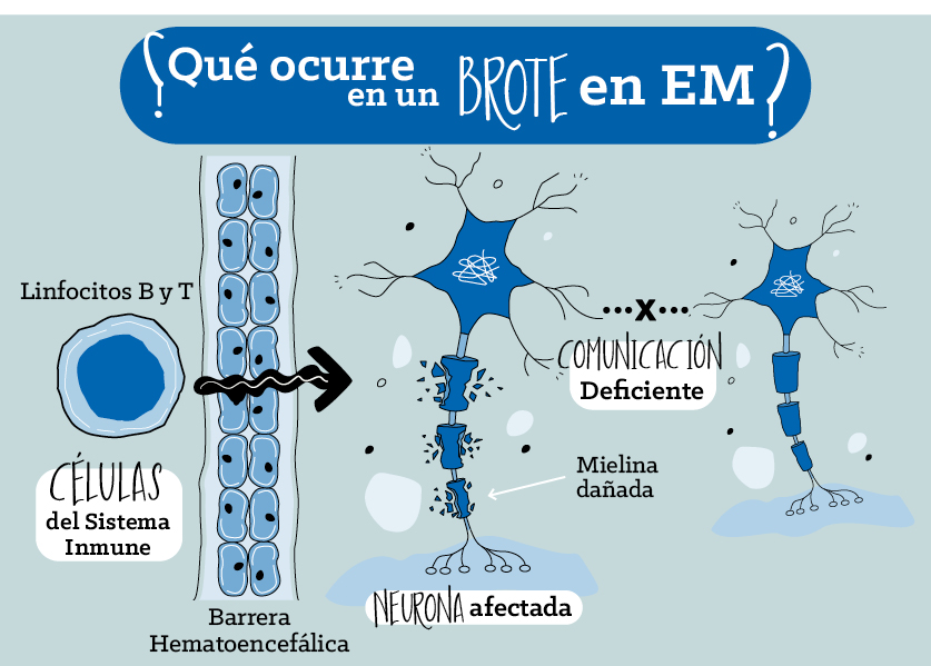 Síntomas Neurológicos Nuevos: Posible Brote de EM