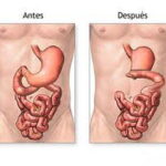 Úlceras estomacales: tratamiento y cuándo operar