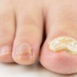 Uñas Gruesas: Causas y Factores de Riesgo