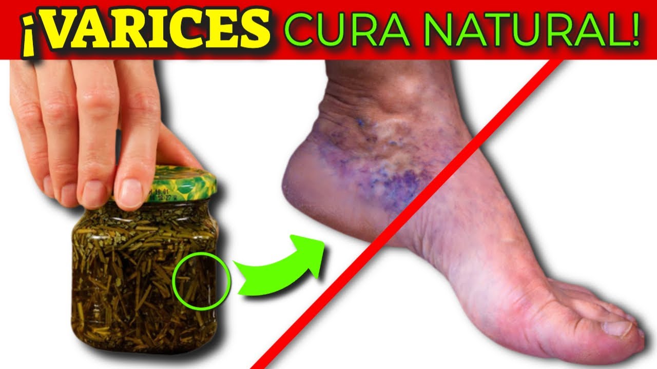 Várices: Remedios naturales para aliviarlas